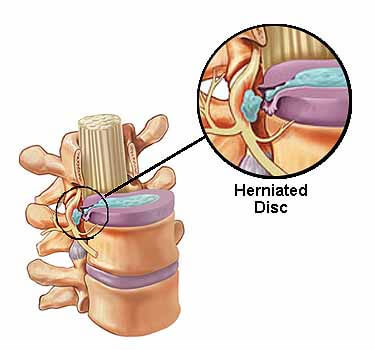 Herniated Disc and NUCCA